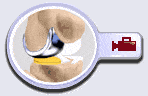 Unicondylar (Unicompartmental) Knee Replacement